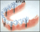 Implant dentar